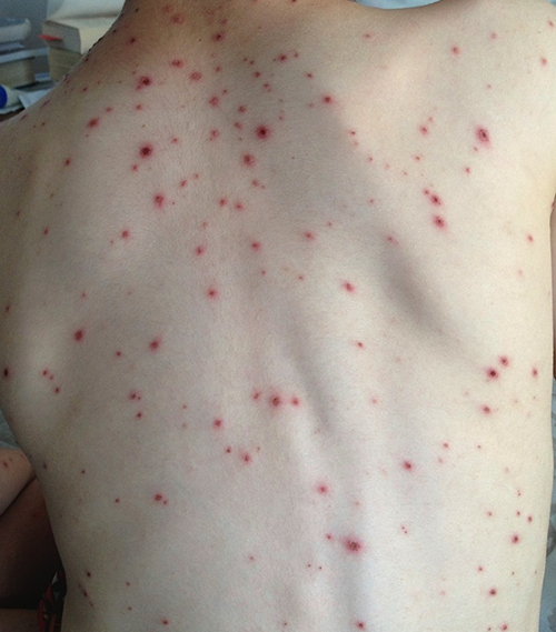 chickenpox-kidshealth-nz